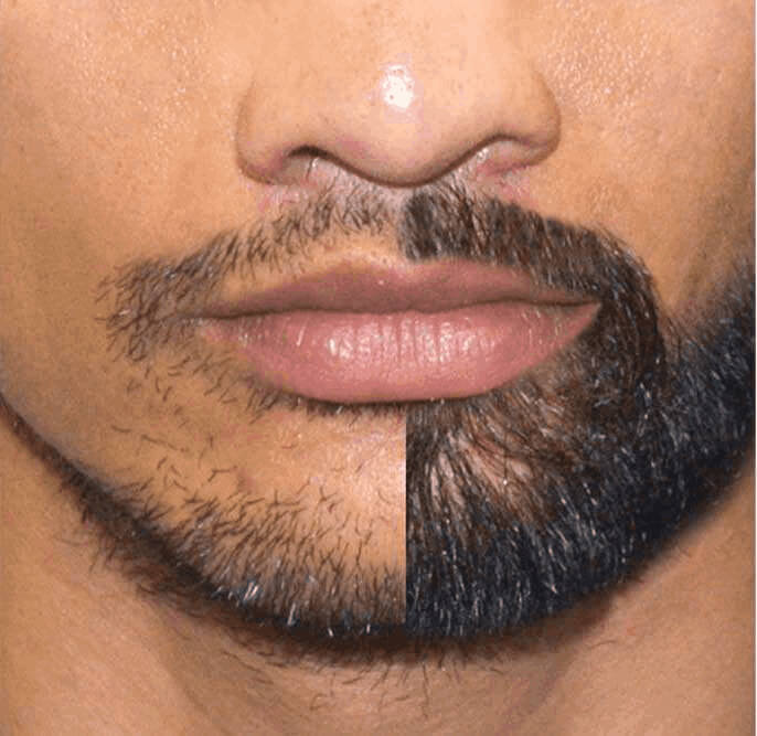 Barttransplantation