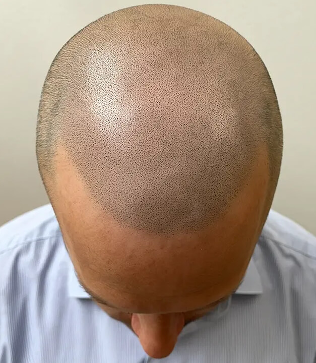 Haarpigmentierung